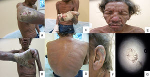 Clinical manifestations of crusted scabies infection (A)–(C) Hyperkeratotic dermatosis with an acral distribution and nail dystrophy; (D) disseminated excoriations, crusts and scaling in the back; (E) and (F) leonine facies, pruritus and scaling, also crusts in the ear; (G) microscopic section of S. scabiei mite showing six legs and the bite apparatus.