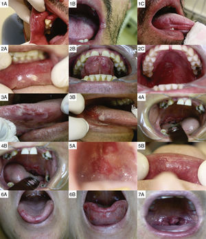 Photographs of the oral lesions of each patient.