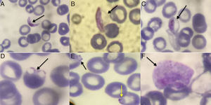 Malaria diagnosis: still a challenge in non-endemic countries | The ...