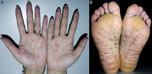 Photograph of the palms and soles of the patient at consultation. There were multiple maculopapules symmetrically distributed over the palms (a) and the soles (b), ranging from 2 to 10cm in diameter. Many of them showed the sign of Biett's Collarette, which is characterized with a central clearing and a rim of collarette scales with surrounding erythema.