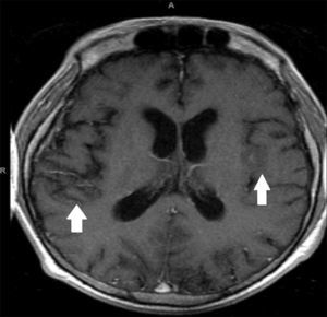 Magnetic resonance imaging of the brain showing areas of abnormal parenchymal signal intensity (arrows) involving cortex and subcortical white matter within the frontal lobes, right temporal lobe, and left insula.