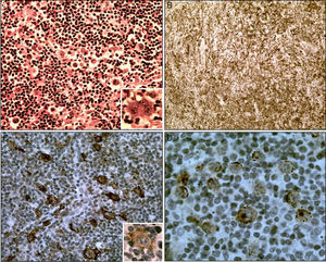 (A) Hodgkin and Reed Sternberg-like cells in a background of small-to medium-sized lymphocytes, H&E stain, 400×; inset shows a RS-like cell with prominent nucleoli, 560×. (B) Background with CD25+ lymphocytes, 125×. (C) CD30+ Hodgkin and Reed–Sternberg-like cells, 400×; in inset a CD20+ cell (800×). (D) CS1-4+ Hodgkin and RS-like cells, 800×.