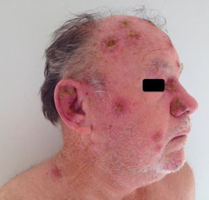Multiple cutaneous ulcerovegetative and ulcero-crusted reddish lesions were observed on the ears, face, and scalp. Superficial involvement of mucosae was recognized on the nose.