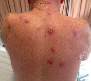 Papules, nodules, infiltrated erythemas were found on the dorsum. Induration of the lesions was palpable.