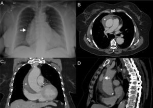 Frontal chest X-ray (A) shows enlargement of the right heart border. Transaxial, contrast-enhanced computed tomography (B) image showing dilatation of the ascending aorta end evidence of type A aortic dissection (*). Coronal (C) and sagittal oblique (D) contrast enhanced computed tomography images showing a type A aortic dissection (*) and the point of intimal tear (arrow).