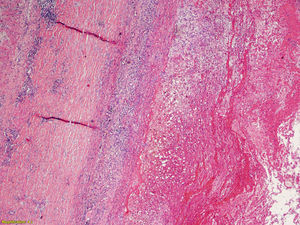 Histologic section of the ascending aorta showing adventitial and medial chronic inflammatory infiltrate. 4 magnification. Section stained with hematoxylin eosin (HE).