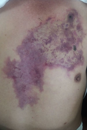 Livedoid plaque on chest showing pale, congestive and ecchymotic areas resulting from ischemic and hemorrhagic phenomena after Loxosceles laeta bite.