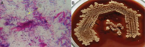 Actinomycotic sulfur granules showing (A) Gram-positive branching filaments ×1000, and (B) colony morphology on anaerobic culture.
