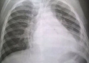 X-ray reveals an acute respiratory distress syndrome (ARDS).