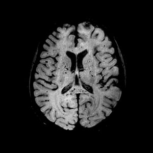 Magnetic resonance axial SWI (Susceptibility weighted imaging), at the level of the basal ganglia, shows multiple hypointense foci suggestive of petechial hemorrhages or possibly microthrombi in the white matter (subcortical and within the corpus callosum) and internal capsules and basal ganglia.