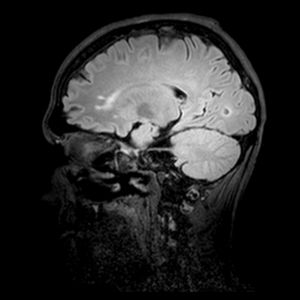 Magnetic resonance sagittal FLAIR weighted image, shows hyperintense foci in the anterior portion of the corpus callosum.