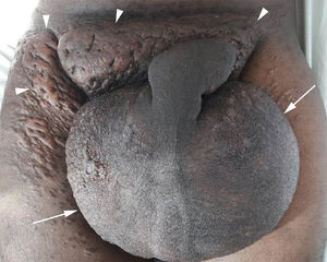 Enlarged scrotum (arrows) and diffuse skin thickening (arrowheads).