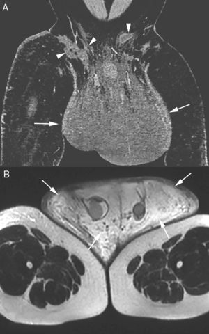 Post-contrast coronal computed tomography of the pelvis (A) showing isodense scrotal enlargement (arrows) with multiple fistulous tracts (arrowheads) in the right inguinal region. T2-weighted magnetic resonance image of the pelvis (B) showing hyperintense scrotal enlargement due to significant subcutaneous edema (arrows).