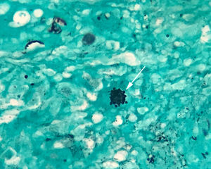 Histopathology of the right inguinal cutaneous biopsy: silver stain reveals yeast forms budding from the central parent yeast (“ship's wheel” appearance; arrow).