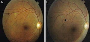 Composite retinography obtained from patient 1. Image (A) shows two choroidal nodules located in the superior temporal arcade of the right eye before tuberculosis treatment, and image (B) shows grayish choroidal scars after 60 days of anti-tuberculosis therapy.