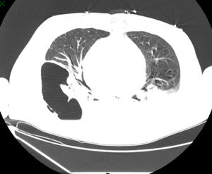 Chest TC consolidation with lung fluid levels suggestive of pulmonary cavitation due to necrosis.