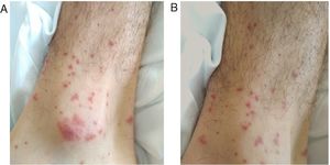 Palpable non-blanching purpuric rash compatible with cutaneous vasculitis in left (A) and right (B) ankles.