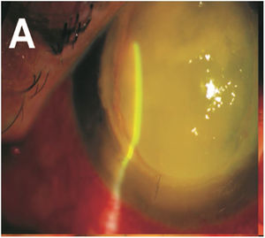 Optical biomicroscopy image showing a dense temporal corneal ulcer with poorly defined edges and 3mm hypopyon.