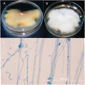Fusarium reverse (A) and surface colony (B) on SDA culture after 1 week of incubation at 25°C. Microscopy of F. solani lactophenol cotton-blue stain with abundant macroconidia and ellipsoidal microconidia (0–1-septate) observed by microcultivation in a 7-day old culture: Note the conidiophores and conidia (C), ×400bar 200μm.