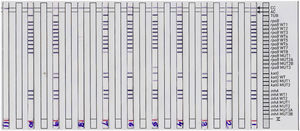 Representative DNA strip patterns of GenoType MTBDR-plus strip. Lane 1, M. tuberculosis complex H37Rv laboratory control strain (rpoB, katG, inhA WT); Lane 3, 4, 6, 9 & 10sensitive to Rifampicin (RIF) and Isoniazid (INH); Lane 2, INH monoresistant (katG S315T1 mutation) Lane 5, MDR-TB (rpoBS531L andkatGS315T1 mutation); Lane 7, RIF monoresistant (rpoB unknown mutation); Lane 8, TUB band absent (LPA invalid) Lane 11, DNA negative control.