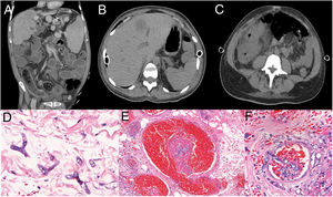 A. Abdomen CT showing colonic wall thickening, mural striation, mesenteric soft-tissue infiltration, increased pericolonic fat mimetizing distal intestinal obstruction syndrome. B. Abdomen CT showing hepatic abscess; C. Increased densification of the colon. D. Large hyphae, rare septations and irregular ramifications at right or acute angle, thin, irregular walls. E. Thrombosis (mycotic thrombi), vascular necrosis and subsequent infarction, and ischemic/hemorrhagic necrosis of affected tissues. F. Angioinvasion, with thrombosis (mycotic thrombi). (D H&E 100x; E H&E 40x; F H&E 40x).