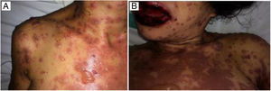 Cutaneous lesions at hospital admission (a) and during treatment (b), revealing epidermis detachment from the underlying dermis, leading to bullae.