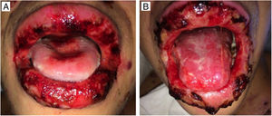 (a, b) Erythematous, hemorrhagic, painful erosions of the oral mucosa and lips at different moments.