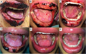 (a–f). Concentric, round, erythematous and well-limited erosions on tongue surface (a, b), that increased in size and coalesced (c–e) until remission (f).