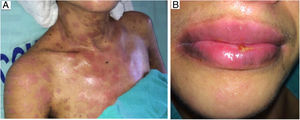 (a, b) Remission of dermal lesions (a) and of mouth mucosa (b).