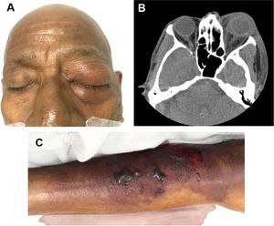 Ocular and lower member Aeromonas infection. (A) Postseptal cellulitis by carbapenem-resistant Aeromonas infection. (B) Axial CT scan showing an increased volume and density of the left periorbital soft tissues associated with ocular proptosis and enhancement of the orbital septum. Alteration in intraconal fat density with laminar fluid in the posterior and medial region of the eyeball. (C) Soft-tissue infection by carbapenem-resistant Aeromonas in the right lower limb.