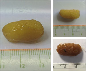 Macroscopic appearance of metformin XR remainders (ghost tablets) as soft amorphous masses in fecal samples mimicking parasitic elements.