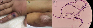 Human cutaneous anthrax in Patient 2. A) Cutaneous anthrax symptom of black eschar and edema on the right index finger; B) Regression of the skin damage after penicillin treatment; C) blood cultures were positive and identified as Bacillus anthracis.