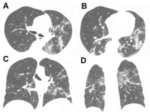 Computed tomography of the chest. Axial slices (A and B) and coronal slices (C and D) showing multiple foci of consolidation and ground-glass opacities in both lungs. There is no evidence of lymph node enlargement or pleural effusion.