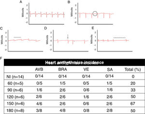 Electrocardiographic analysis of C57BL/6 mice infected with T. cruzi Brazil strain. Heart arrhythmias typification by ECG traces: (A) uninfected animals (NI); (B) T. cruzi-infected mice with atrioventricular block (AVB; black circle), (C) sinus bradycardia (BRA; black line), (D) ventricular extrasystole (VE; arrow) and (E) sinus arrhythmia (SA: traced line). Quantitative analysis of arrhythmia incidence in uninfected and T. cruzi-infected mice (F). A marked increase in cardiac arrhythmias was noticed during the course of T. cruzi chronic infection.