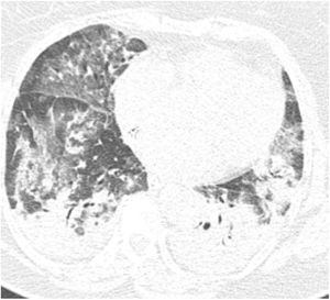 Axial image of chest CT scan showing multiple focal and bilateral ground-glass opacities, interlobular septal thickening and consolidation areas, which are typical pulmonary findings of COVID-19.