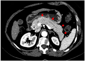 CT scan demonstrating heterogeneously enhancing and edematous pancreas (red arrows).