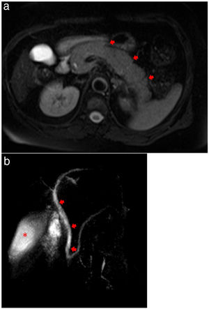 (a) MRCP showing evidence of acute pancreatitis with a diffusely enlarged pancreas (arrows) without focal lesions or gallstones. (b) MRCP showing no extrahepatic biliary duct dilatation (arrows) and homogeneous contrast in gallbladder (asterisk), demonstrating no evidence of choledocholithiasis or cholelithiasis.