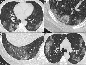 Nonenhanced high-resolution chest CT of different patients with confirmed COVID-19 pneumonia and typical findings. A, 74-year-old man presented with 7-day history of fever and cough. Axial CT shows multifocal, peripheral and rounded ground glass opacities (GGO). B, 47-year-old man presented with 10-day history of moderate breathlessness and fever. Axial CT shows reversed halo sign. C, 70-year-old woman presented with 9-day history of mild dyspnea and COVID-19 exposure. Axial CT shows GGO with a perilobular pattern. D, 36-year-old man presented with 5-day history of fever, cough and myalgia. Axial CT shows bilateral areas of crazy-paving pattern.
