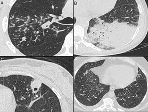 Nonenhanced high-resolution chest CT of different patients with atypical findings. A, 52-year-old man presented with 3-day history of fever, cough and adynamia. Axial chest CT shows centrilobular nodules, tree-in-bud opacities and bronchial mucocele. The patient was diagnosed with pulmonary tuberculosis. B, 26-year-old woman presented with 10-day history of cough, sputum, fever and dyspnea. Axial chest CT shows lobar consolidation. The patient was diagnosed with bacterial acquired community pneumonia. C, 47-year-old woman presented with 30-day history of headache, adynamia, cough and chest pain. Axial chest CT shows pulmonary cavitation with satellite centrilobular opacities. The patient was diagnosed with central nervous system and pulmonary cryptococcosis. D, 55-year-old man presented with 3-day history of orthopnea, precordial pain and cough. Axial chest CT shows bilateral pleural effusion, interlobular septal thickening, and centrilobular ground glass opacities. The patient was diagnosed with congestive heart failure due to myocardial infarction.