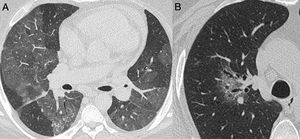 Nonenhanced high-resolution chest CT of different patients with indeterminate findings. A, 40-year-old man presented with 5-day history of worsening of chronic cough, dyspnea and fever. Axial CT shows diffuse and bilateral ground glass opacities. The patient was diagnosed with acquired immunodeficiency syndrome and Pneumocystis pneumonia. B, 55-year-old man presented with 3-day history of cough and mild breathlessness. Axial CT shows unilobar, rounded and peribroncovascular ground glass opacity. COVID-19 pneumonia was confirmed.