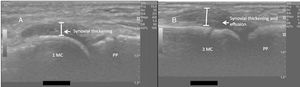Long axis (sagittal) ultrasound view of active synovitis of the first (A) and third (B) metatarsophalangeal joint in a pediatric patient with chronic arthritis retaled to SARS-CoV-2. PP: proximal phalanx; MC: Metacarpal. The images were kinfdly provided by Dr. Leonor Garbin Savarese of the Department of Medical Imaging, Oncology and Hematology, University of São Paulo, Ribeirão Preto.