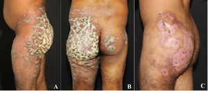 A 26-year-old male farmer presented a verrucous plaque in the left side of the buttock (A), that spread to the right one (B). A marked improvement of the skin lesions caused by M. tuberculosis was observed after treatment, performed with rifampicin, isoniazid, pyrazinamide and ethambutol during six months.