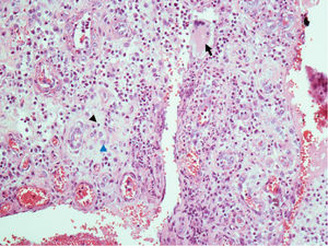 Histological section of the skin stained with hematoxylin and eosin. The dermal inflammatory infiltrate was characterized by the presence of mono and polymorphonuclear cells. Black arrow: giant cell; black arrow head: lymphocyte; blue arrow head: macrophage.