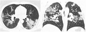 RAD-Covid Score 2. Male patient, 55 years old, with 4 days of symptoms and Covid-19 infection confirmed by rt-PCR. Moderate pulmonary involvement (25-50%). In this case, we see ground-glass opacities with additional confluent consolidations and “crazy-paving” pattern.