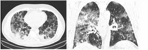 RAD-Covid Score 3. Male patient, 67 years old, with 5 days of symptoms and Covid-19 infection confirmed by rt-PCR. Extensive pulmonary involvement (> 50%). In this case, we see ground-glass opacities, consolidations, septal thickening, and “crazy paving” pattern occupying more than 50% of the total lung volume, with bilateral, peripheral, and central distribution.