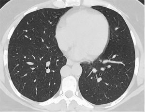 RAD-Covid Score 0. Male patient, 42 years old, with 2 days of symptoms and Covid-19 infection confirmed by rt-PCR. The axial chest CT image shows no relevant pulmonary changes (normal chest CT). The chest CT can be negative in the first days of symptoms (the literature reports up to 50% normal CT in patients with less than 2 days of symptoms) (20).