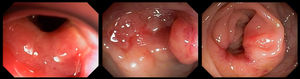 Colonoscopy, descending colon. Stricturing ulcers caused by PCM infection.