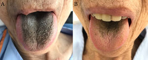 (A) Black hair-like lesion appeared on the dorsal aspect of the patient's tongue 28 days after starting metronidazole treatment. (B) Both black discoloration and hair-like appearance on the patient's tongue were improved 14 days after discontinuing metronidazole treatment.