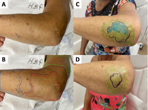 (A) Hypochromatic, hypo-anesthetic macule on the left upper limb; (B) Areas with loss of tactile sensitivity [green dashed area = 0.07 gram-force (normal threshold of tactile sensitivity); blue dashed area = 0.2 g-f; purple dashed area = 2.0 g-f; red dashed area = 4.0 g-f]; (C-D) improvement of tactile sensitivity after five months of multibacillary multidrug therapy.