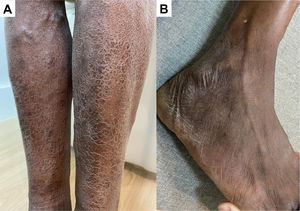 (A) Multiple ichthyosis in islets in the lower limbs; (B) linear thickening of right superficial fibular nerve.